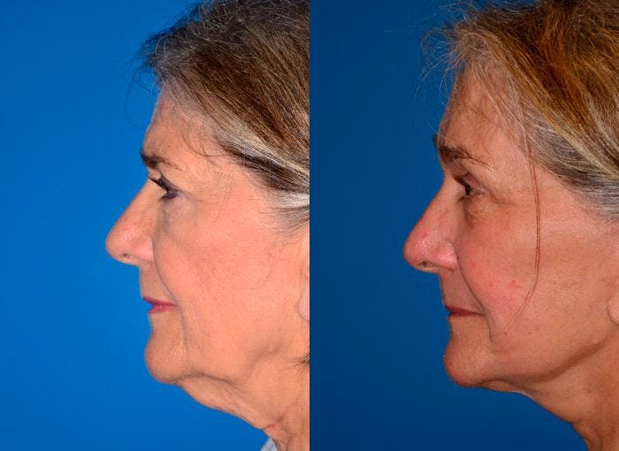 Facelift Before & After Gallery - Patient 122405663 - Image 4