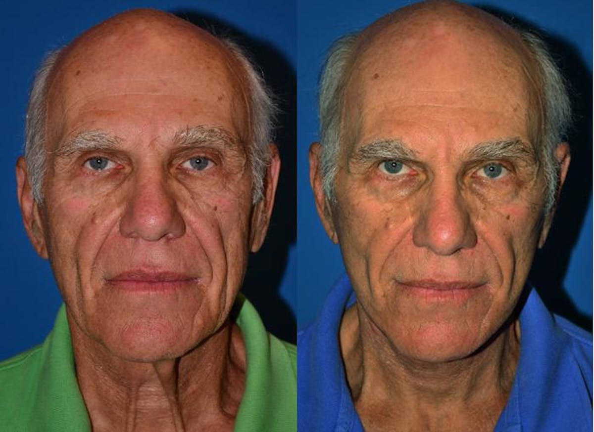 Facelift Before & After Gallery - Patient 122405664 - Image 1