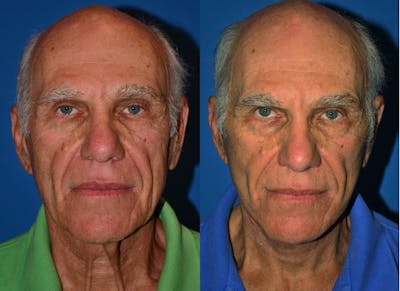 Facelift Before & After Gallery - Patient 122405664 - Image 1