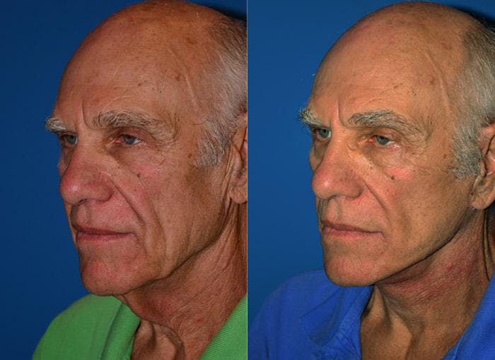 Facelift Before & After Gallery - Patient 122405664 - Image 2