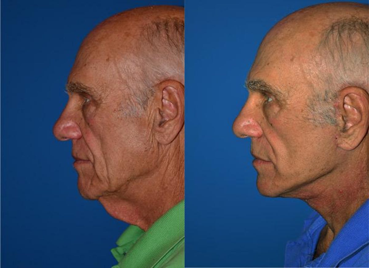 Facelift Before & After Gallery - Patient 122405664 - Image 3