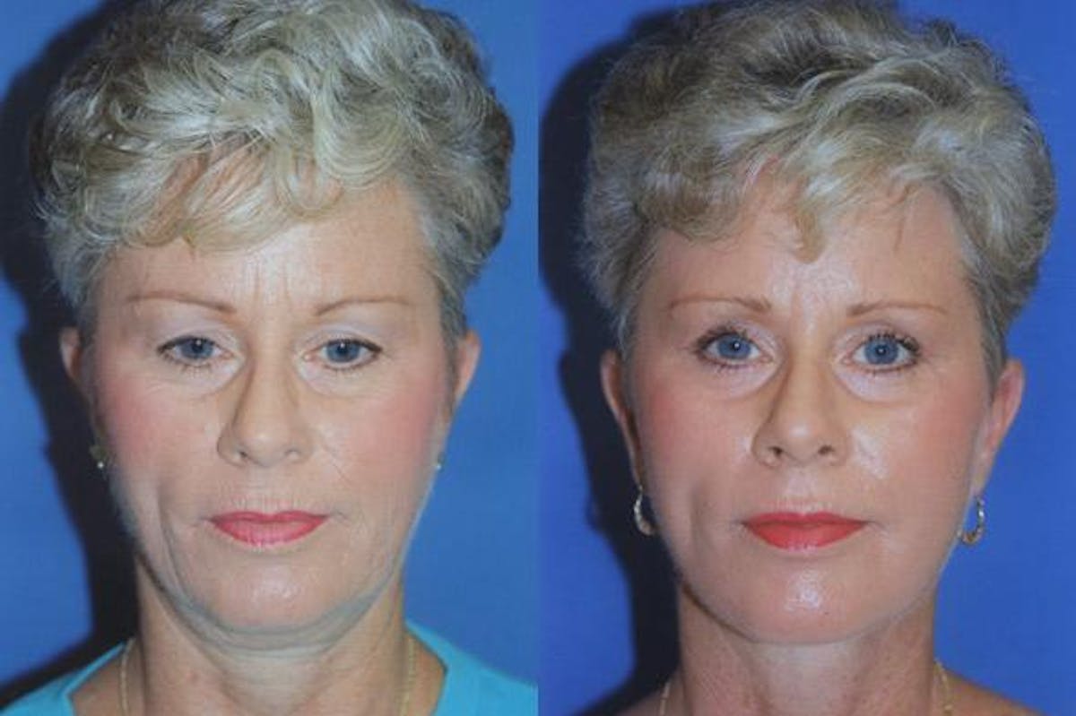 Facelift Before & After Gallery - Patient 122405665 - Image 1