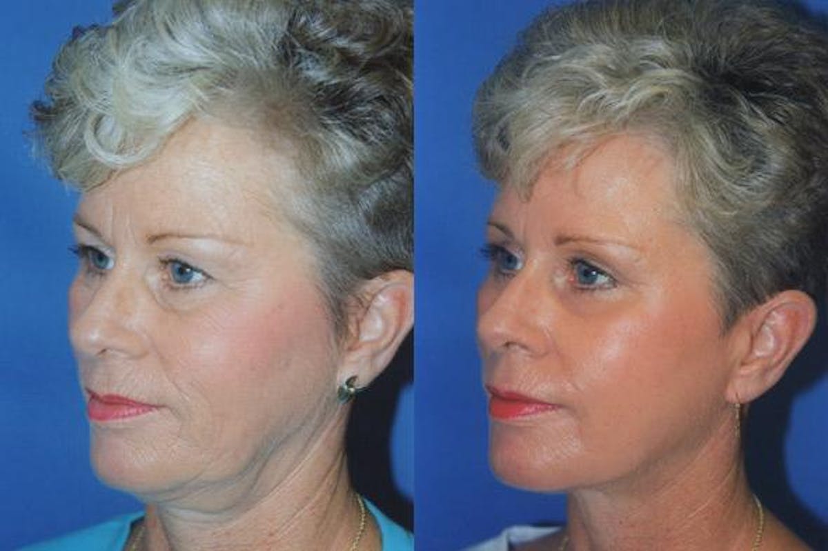 Facelift Before & After Gallery - Patient 122405665 - Image 2