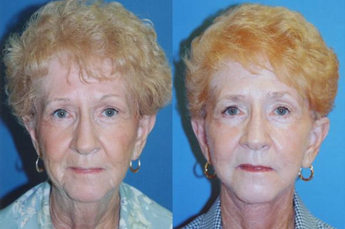 Facelift Before & After Gallery - Patient 122405667 - Image 1