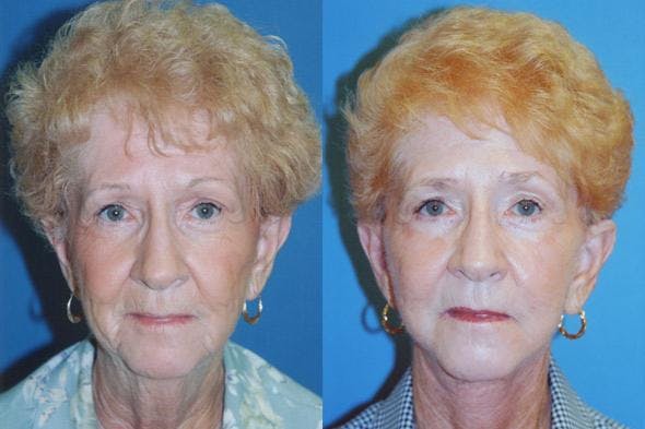 Facelift Before & After Gallery - Patient 122405667 - Image 1