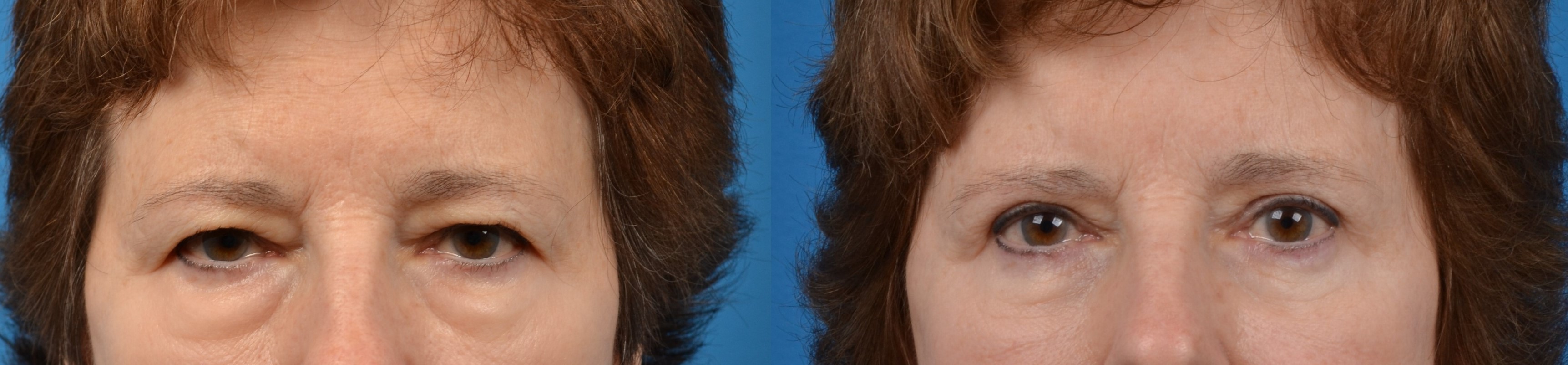 Eyelid Surgery Before & After Gallery - Patient 220228 - Image 1