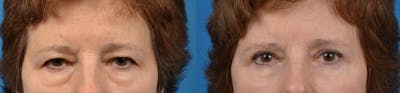 Eyelid Surgery Before & After Gallery - Patient 122405669 - Image 1