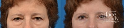 Eyelid Surgery Before & After Gallery - Patient 220228 - Image 1