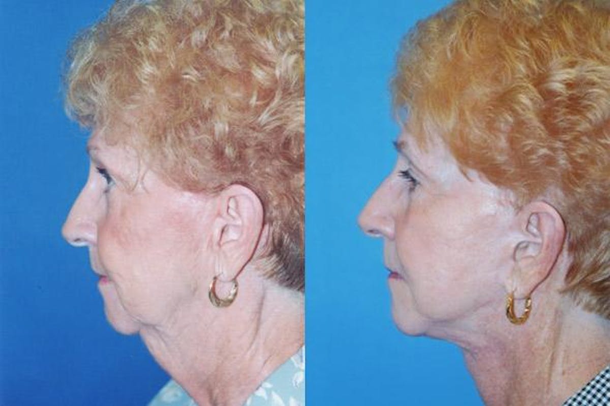 Facelift Before & After Gallery - Patient 122405667 - Image 2