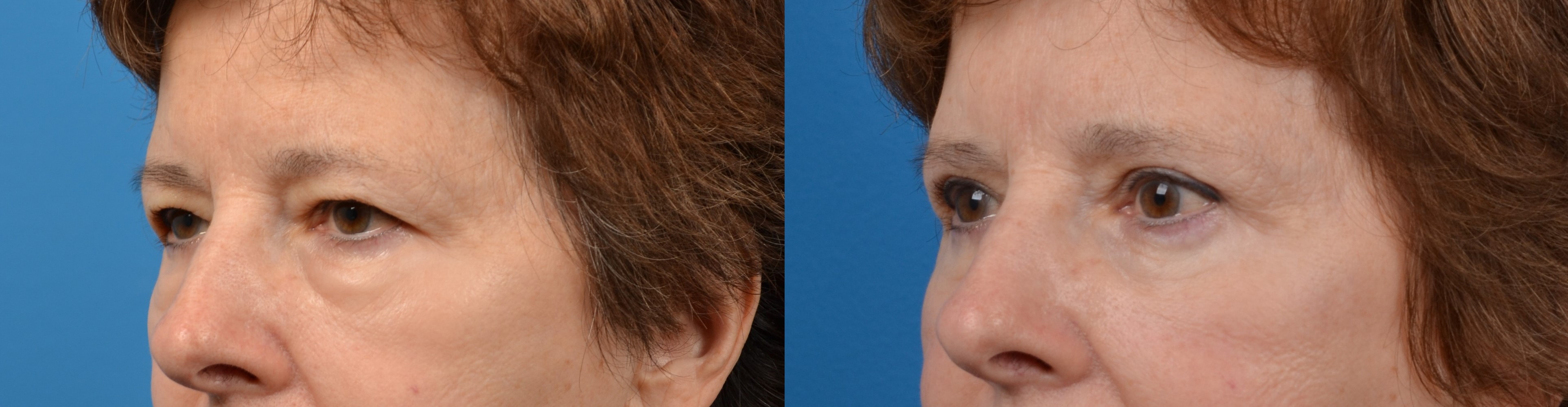 Eyelid Surgery Before & After Gallery - Patient 220228 - Image 2