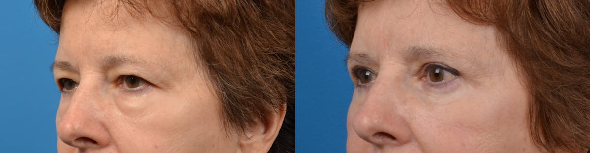 Eyelid Surgery Before & After Gallery - Patient 122405669 - Image 2