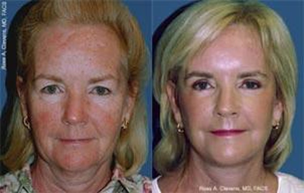 Facelift Before & After Gallery - Patient 122405668 - Image 1