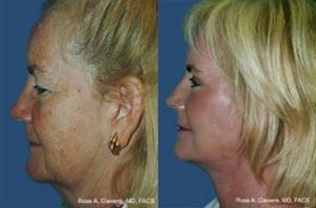 Facelift Before & After Gallery - Patient 122405668 - Image 2