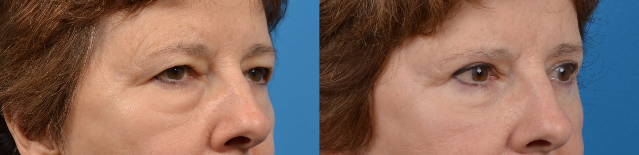 Eyelid Surgery Before & After Gallery - Patient 122405669 - Image 3