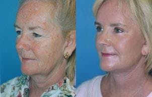 Facelift Before & After Gallery - Patient 122405668 - Image 3