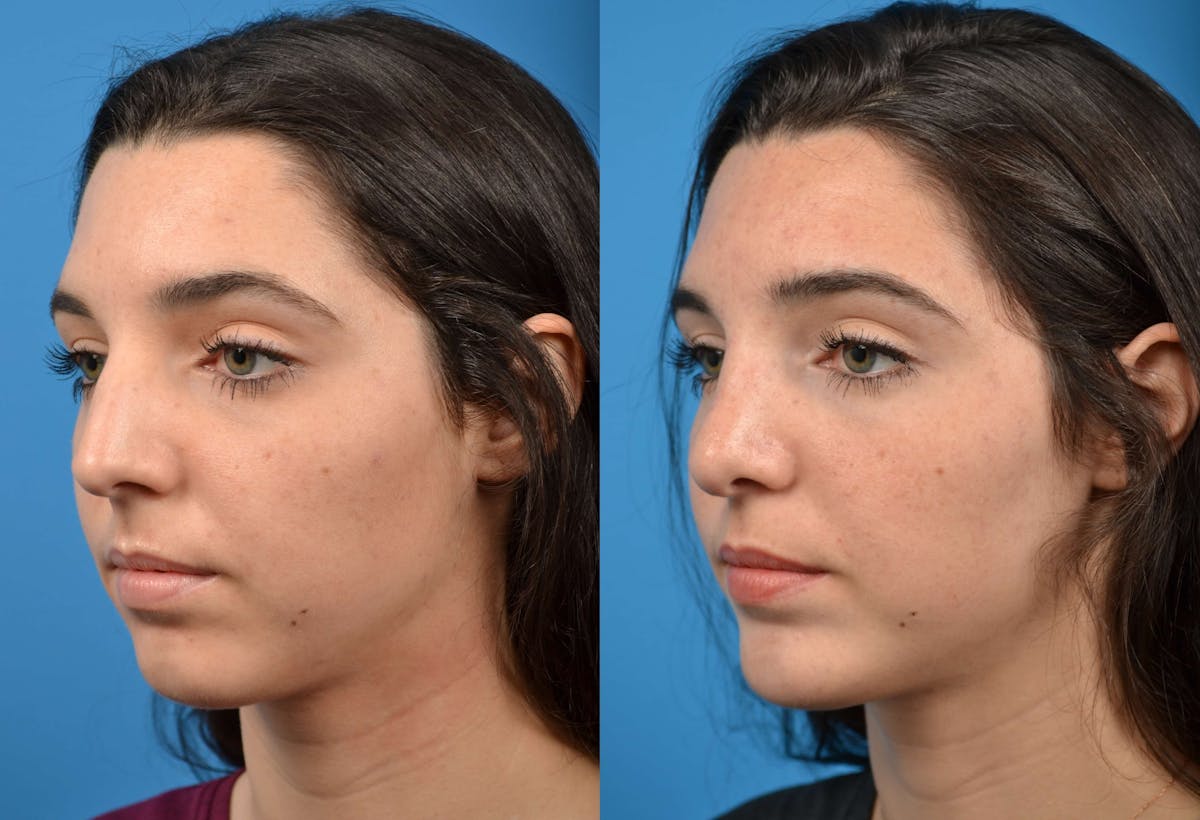Facial Implant Before & After Gallery - Patient 122405672 - Image 2