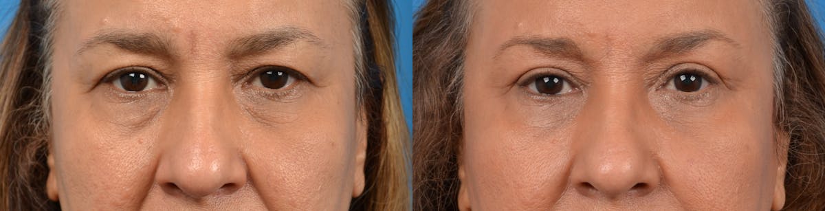 Eyelid Surgery Before & After Gallery - Patient 122405673 - Image 1