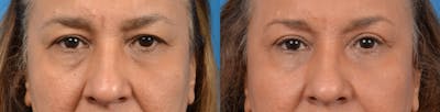 Eyelid Surgery Before & After Gallery - Patient 122405673 - Image 1