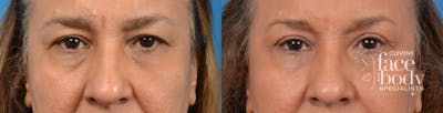 Eyelid Surgery Before & After Gallery - Patient 170862 - Image 1
