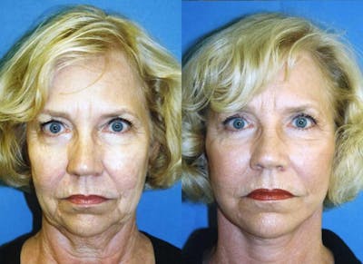 Facelift Before & After Gallery - Patient 122405670 - Image 1