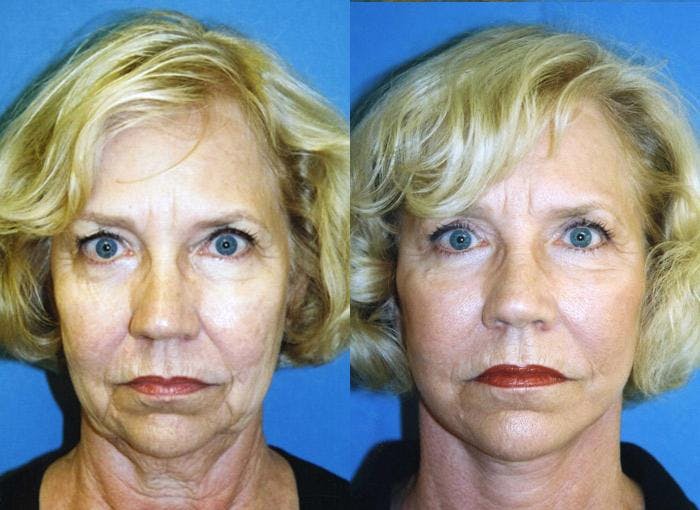 Facelift Before & After Gallery - Patient 122405670 - Image 1