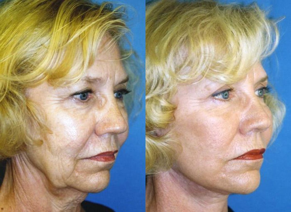 Facelift Before & After Gallery - Patient 122405670 - Image 2