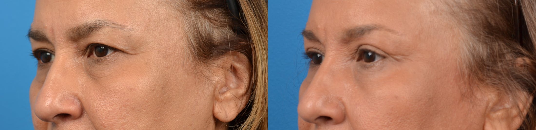 Eyelid Surgery Before & After Gallery - Patient 122405673 - Image 2
