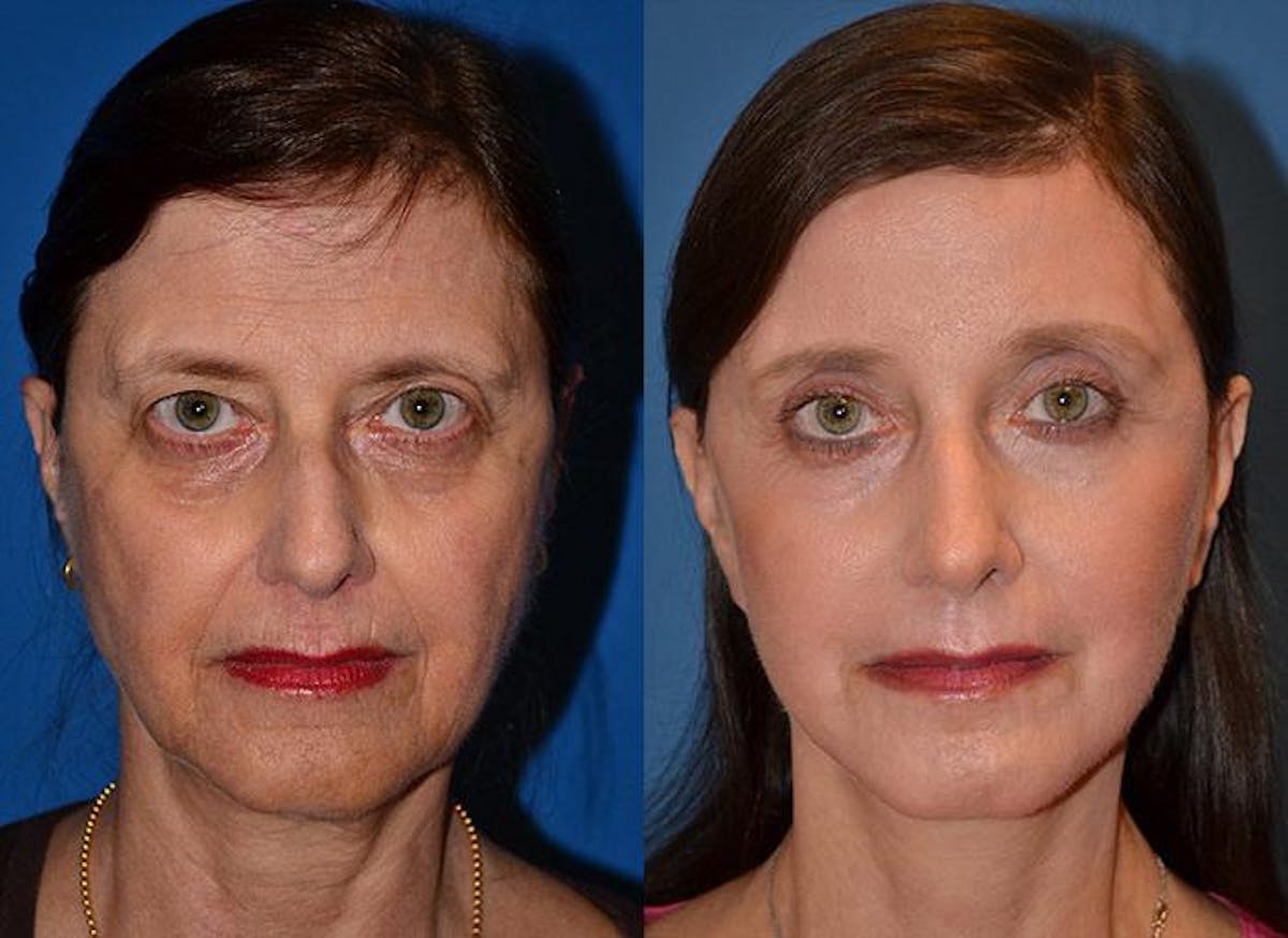 Facelift Before & After Gallery - Patient 122405671 - Image 1