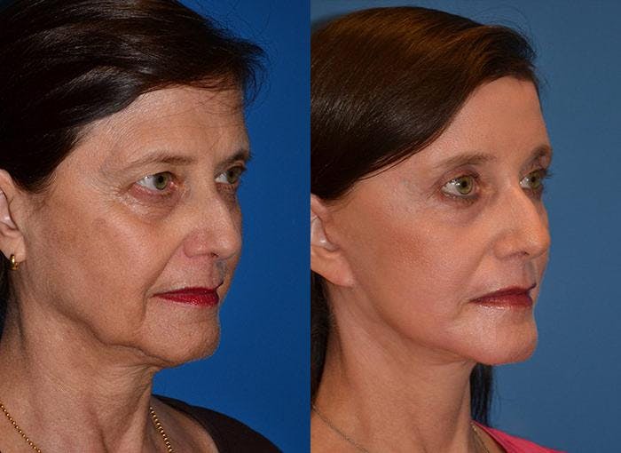 Facelift Before & After Gallery - Patient 122405671 - Image 2