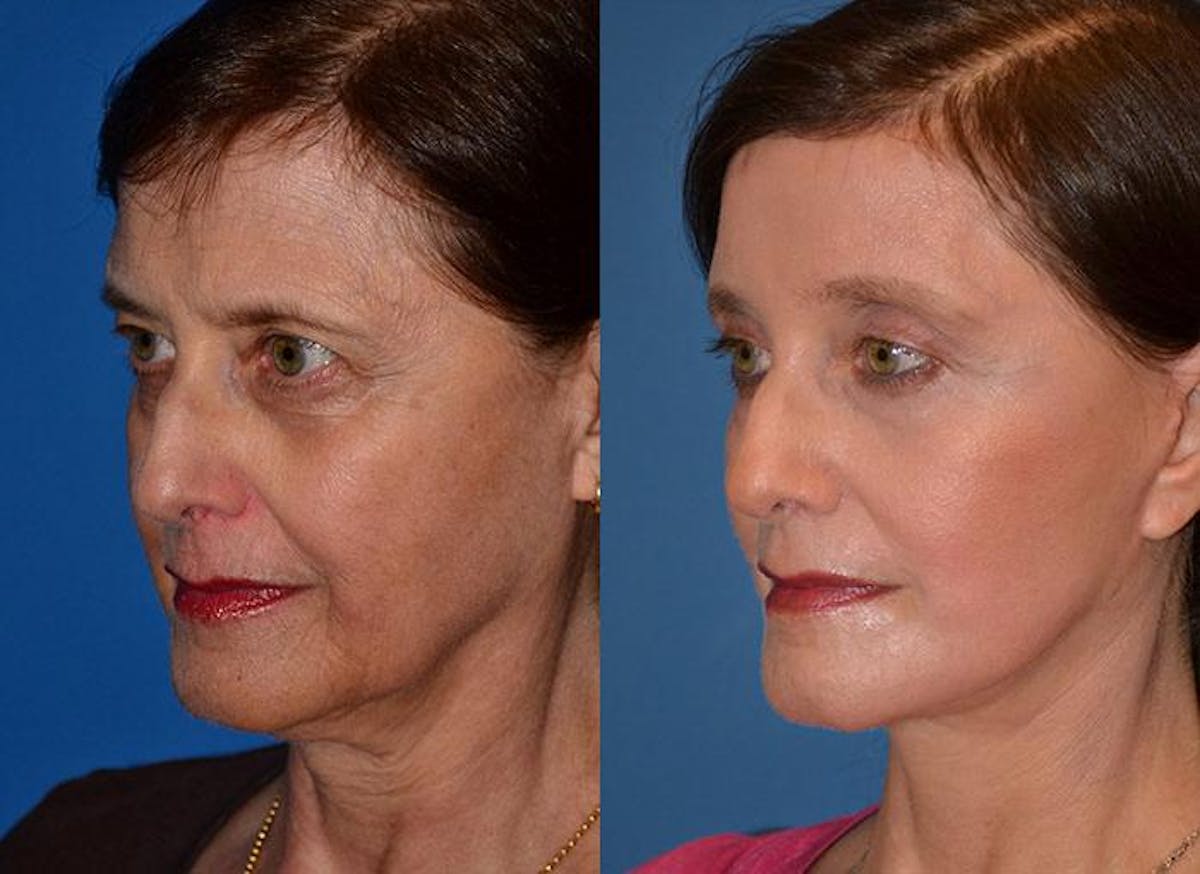 Facelift Before & After Gallery - Patient 122405671 - Image 3