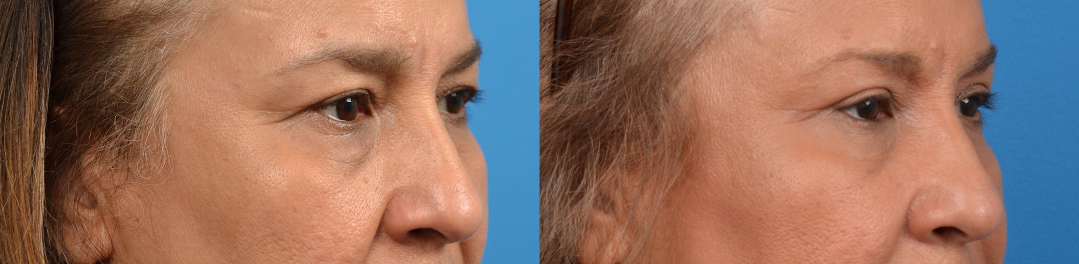 Eyelid Surgery Before & After Gallery - Patient 122405673 - Image 3