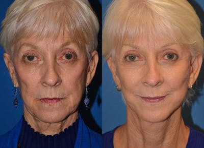 Facelift Before & After Gallery - Patient 122405674 - Image 1
