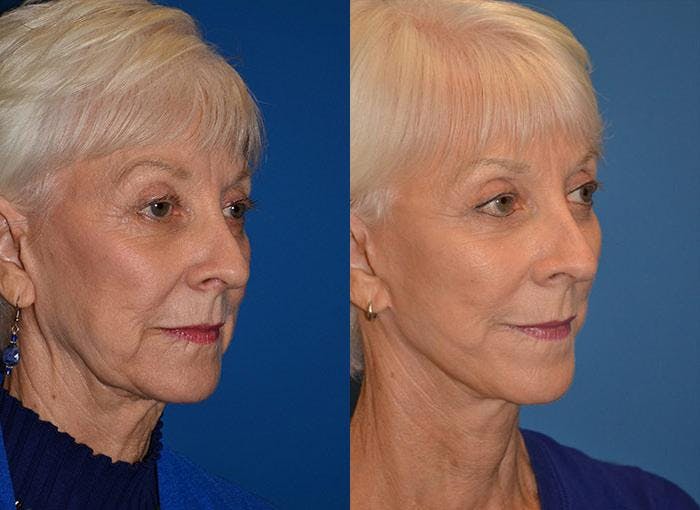 Facelift Before & After Gallery - Patient 122405674 - Image 2