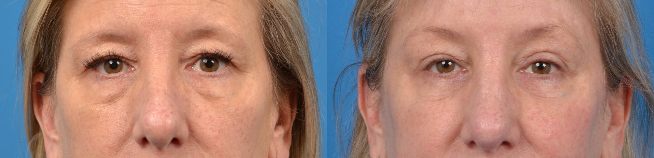 Eyelid Surgery Before & After Gallery - Patient 122405677 - Image 1