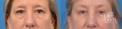 Eyelid Surgery Before & After Gallery - Patient 107942 - Image 1