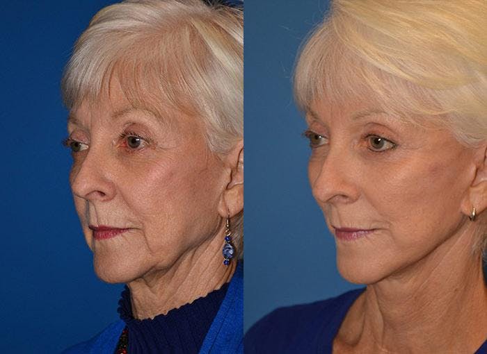 Facelift Before & After Gallery - Patient 122405674 - Image 3