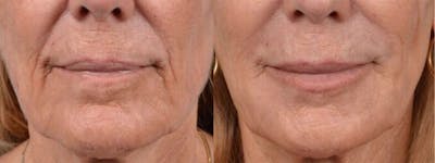 Dermal Fillers Before & After Gallery - Patient 122405675 - Image 1