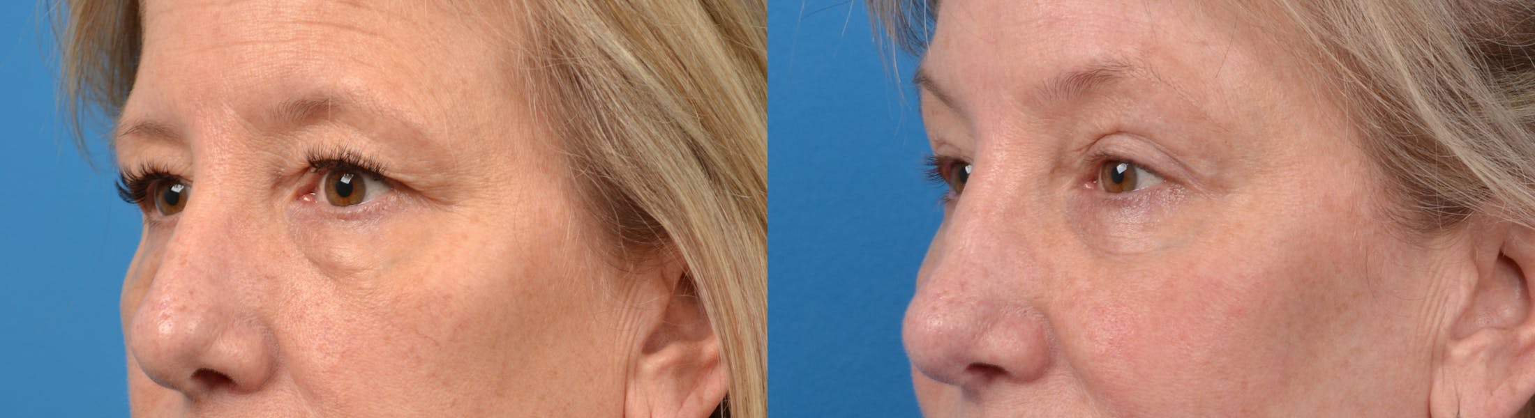 Eyelid Surgery Before & After Gallery - Patient 122405677 - Image 2