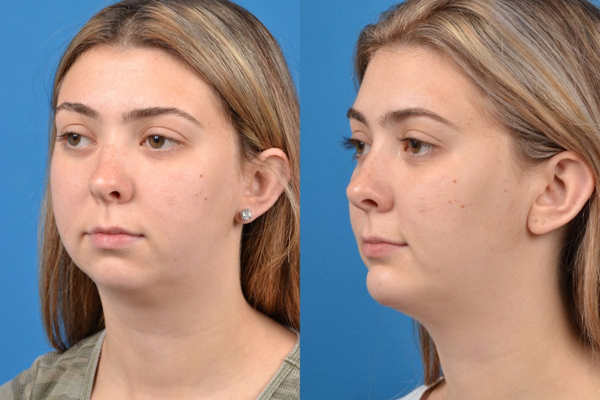 Facial Implant Before & After Gallery - Patient 122405680 - Image 2