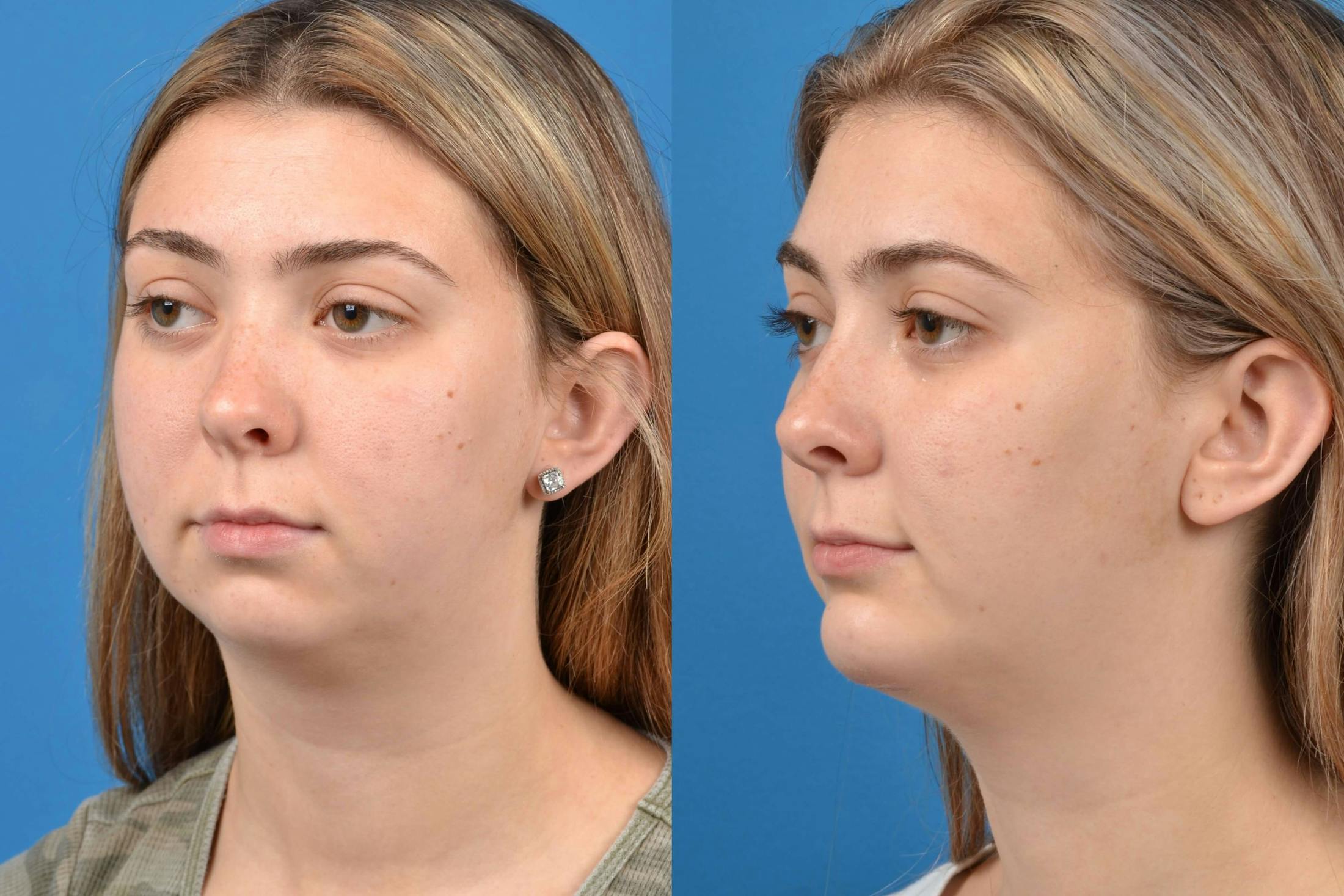 Facial Implant Before & After Gallery - Patient 122405680 - Image 2
