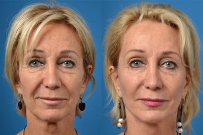 Dermal Fillers Before & After Gallery - Patient 122405678 - Image 1