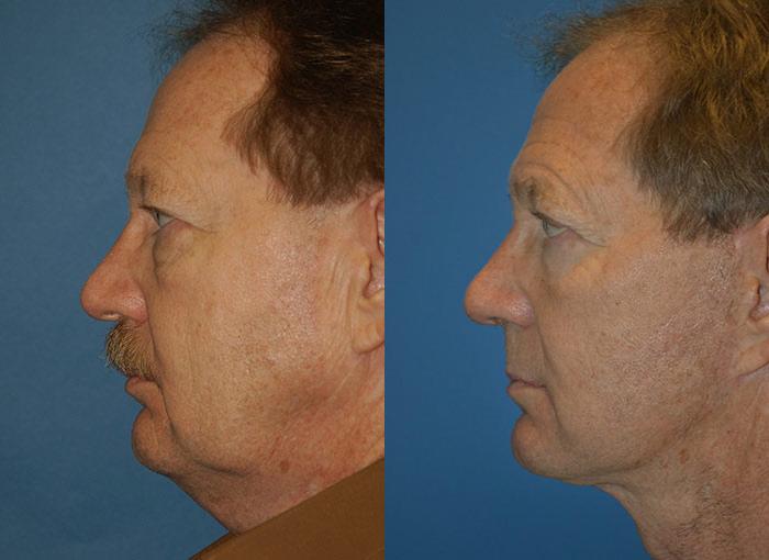 Facelift Before & After Gallery - Patient 122405676 - Image 2