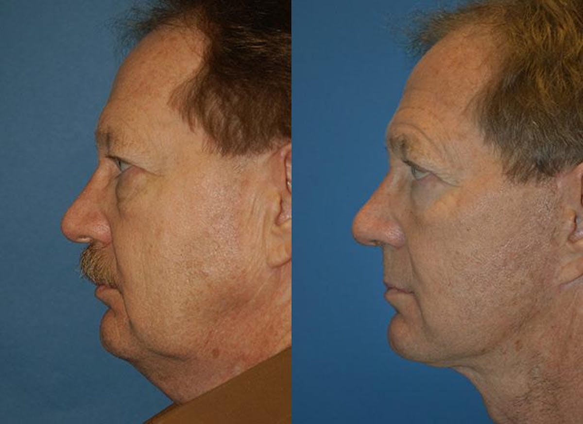Facelift Before & After Gallery - Patient 122405676 - Image 2