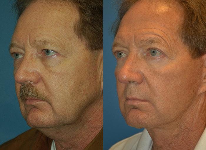 Facelift Before & After Gallery - Patient 122405676 - Image 3