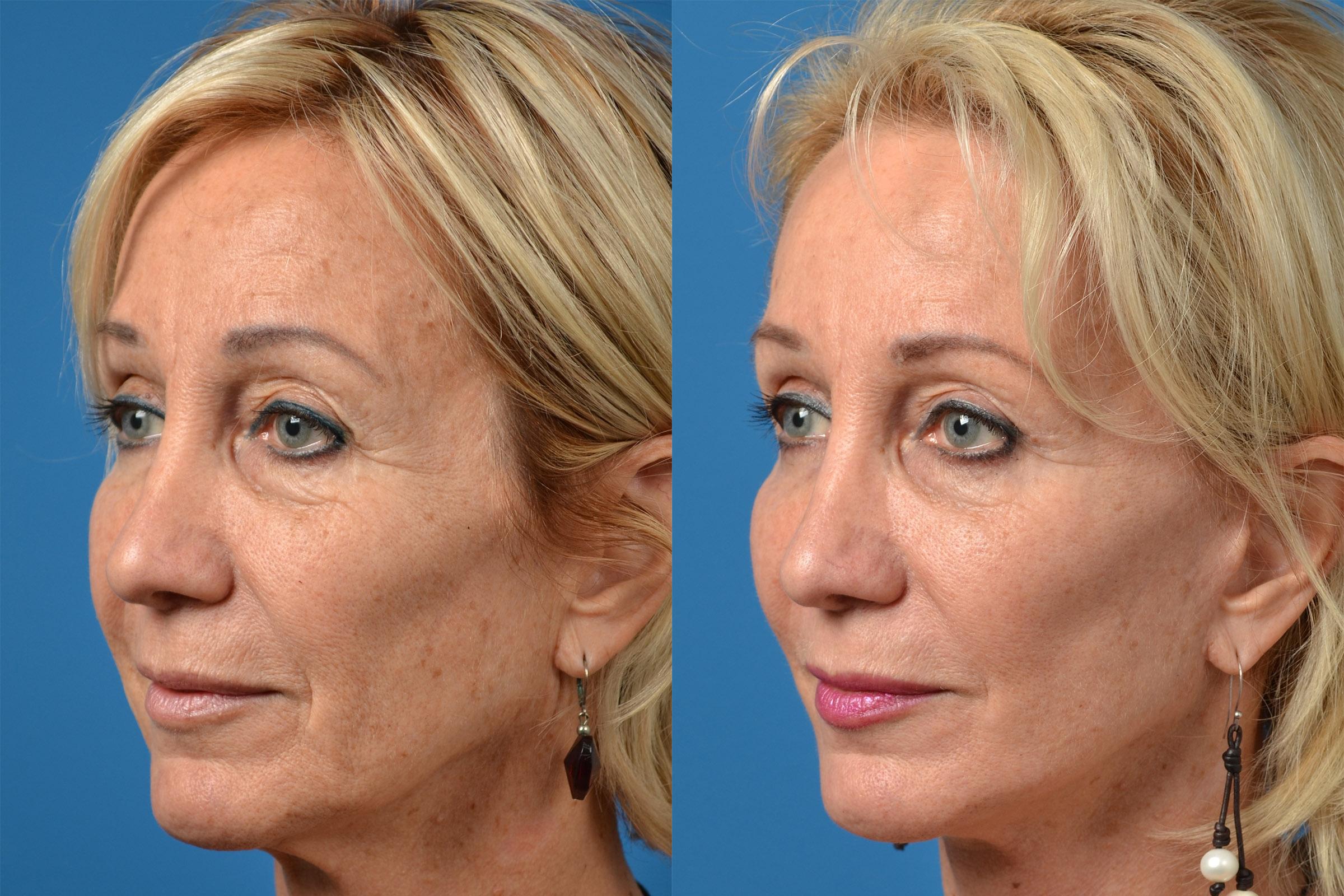 Dermal Fillers Before & After Gallery - Patient 122405678 - Image 2