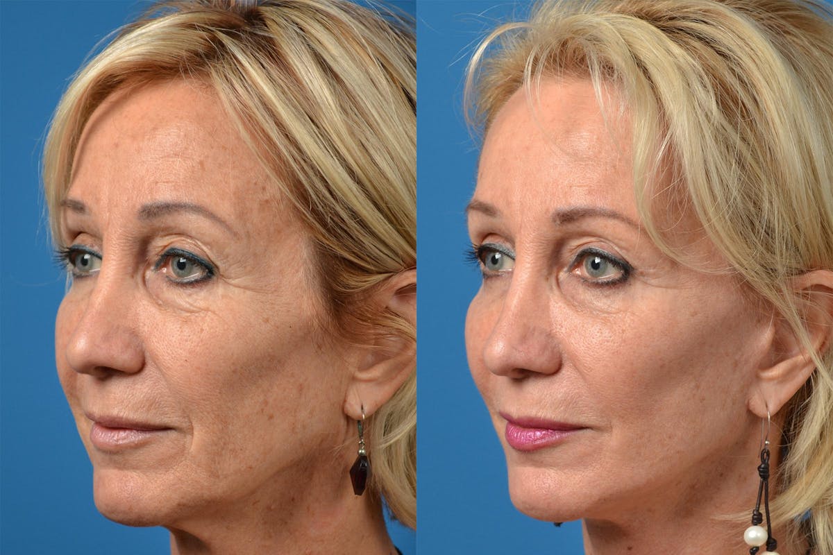 Dermal Fillers Before & After Gallery - Patient 122405678 - Image 2