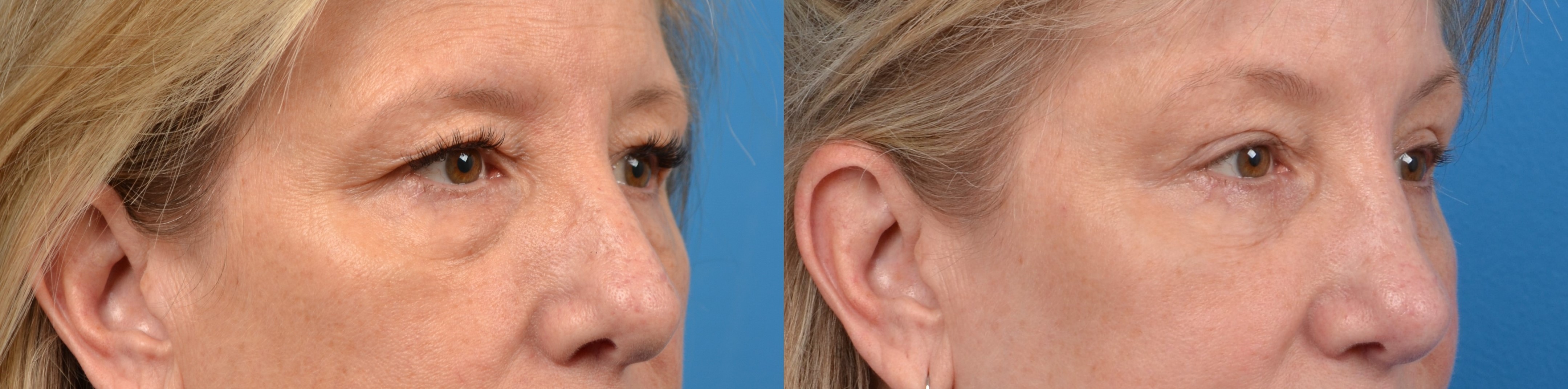 Eyelid Surgery Before & After Gallery - Patient 107942 - Image 3