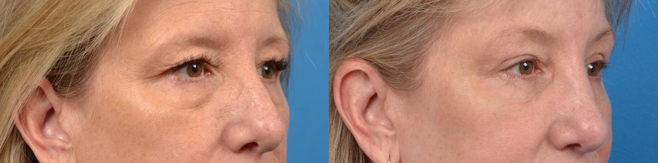 Eyelid Surgery Before & After Gallery - Patient 122405677 - Image 3