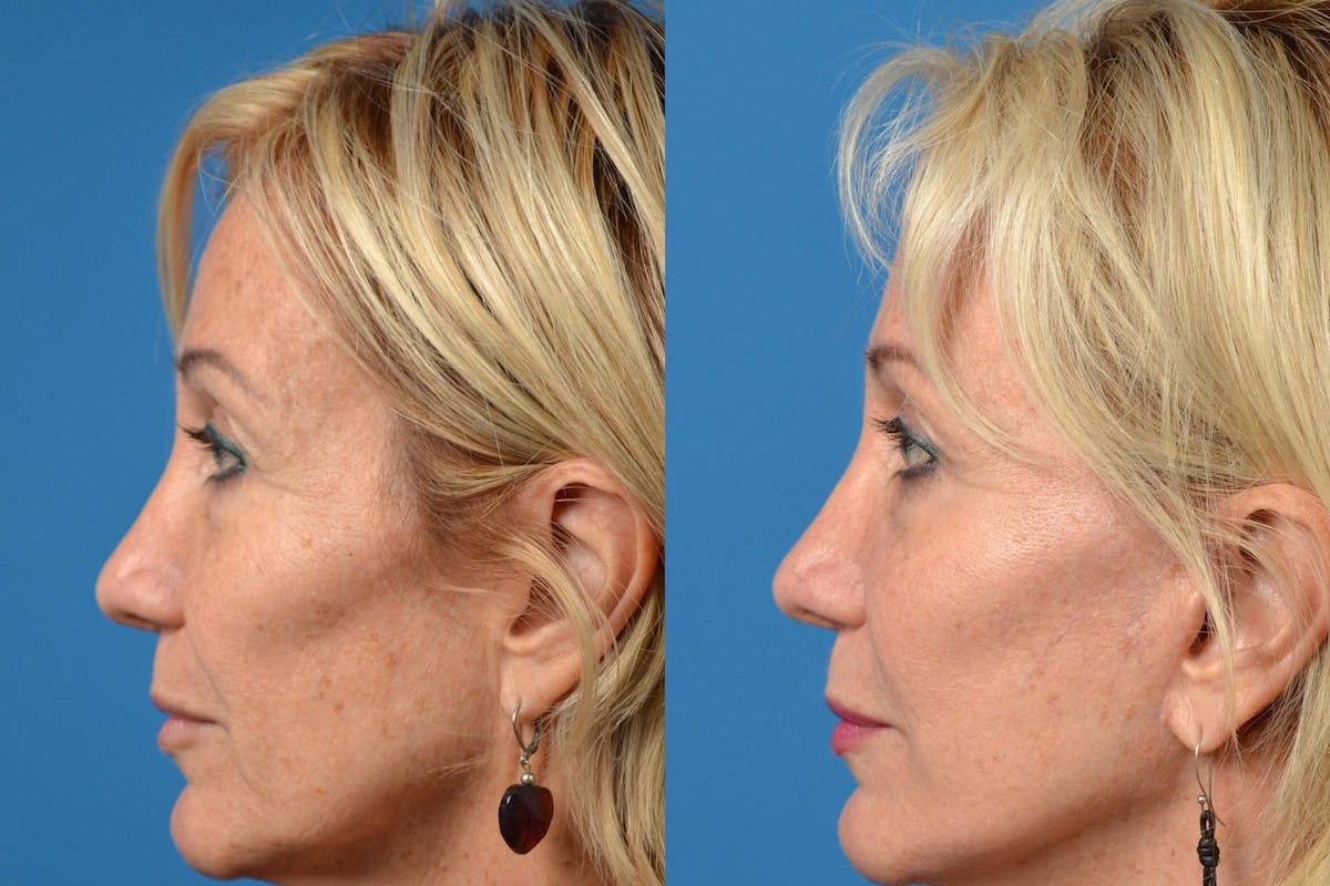 Dermal Fillers Before & After Gallery - Patient 122405678 - Image 3