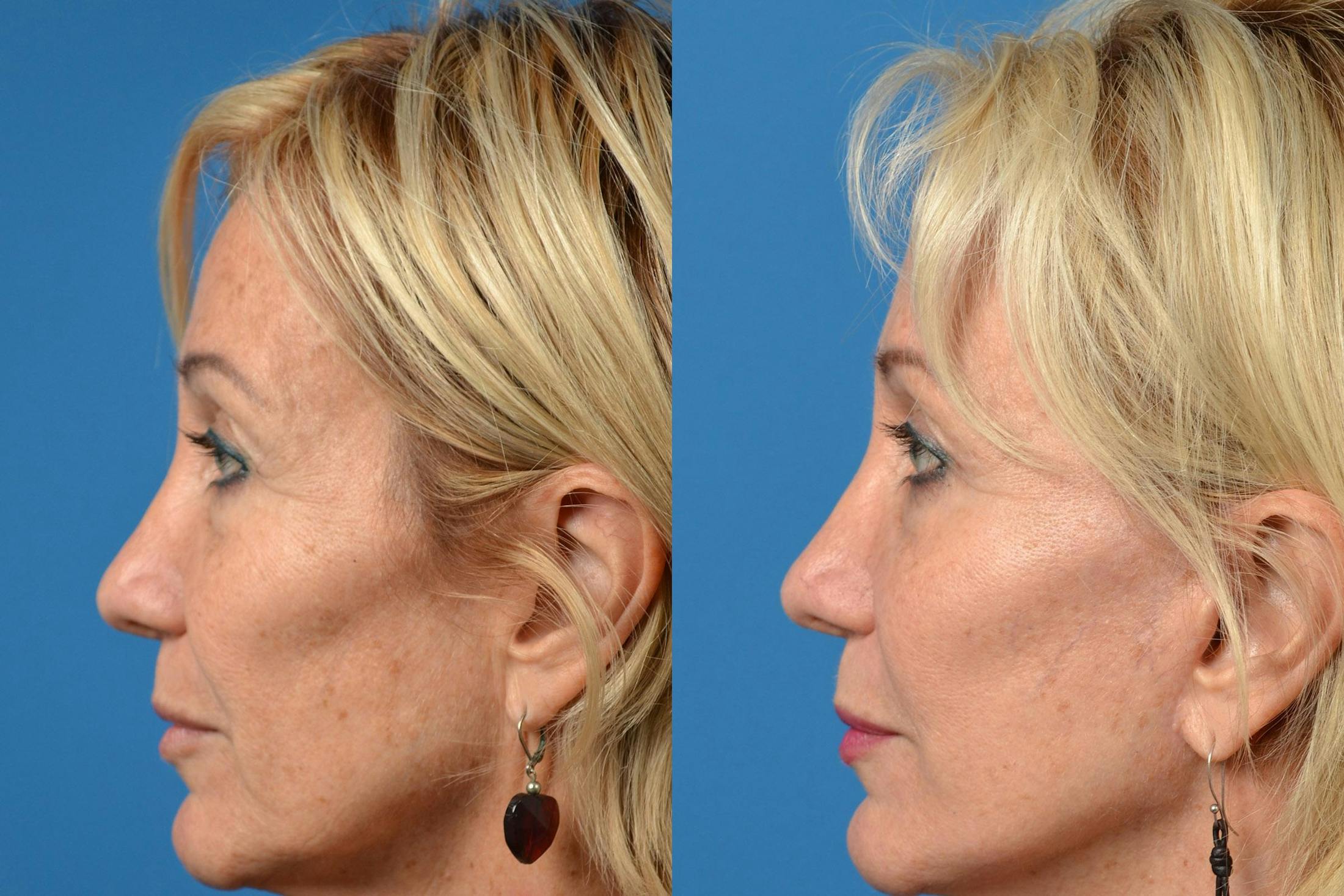 Dermal Fillers Before & After Gallery - Patient 122405678 - Image 3